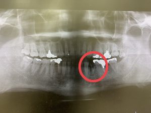インプラント実例掲載＞  歯が一本、欠損ならインプラントはどうでしょうか？