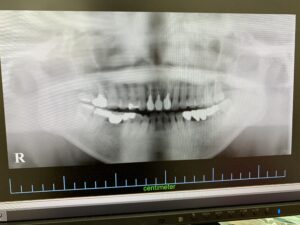 ＜インプラント実例掲載＞奥歯に3本インプラント埋入した症例