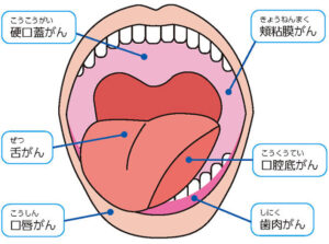 口腔がん手術後に皮弁はどのような状態になるでしょうか