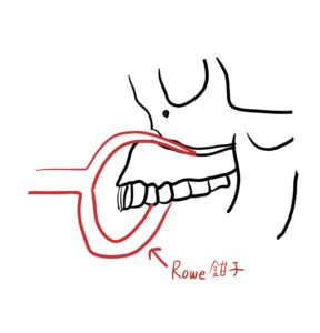 上顎骨骨折整復の手術について解説しました