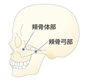 頬骨弓骨折の治療について知っていますか？