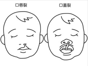 Passavant隆起って言葉の意味を知っていますか？