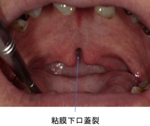 粘膜下口蓋裂について知っていますか？