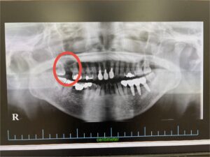 ＜インプラント実例掲載＞サージカルガイドを用いてインプラントを埋入した症例