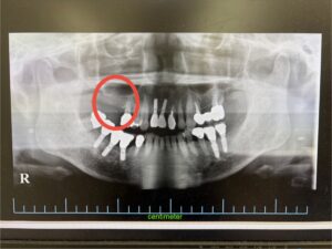 ＜インプラント実例掲載＞サージカルガイドを用いてインプラントを埋入した症例