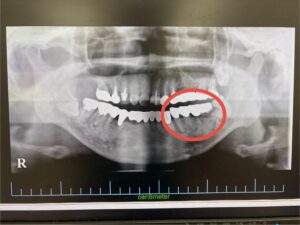 ＜インプラント実例掲載＞サージカルガイドを用いてインプラントを埋入した症例