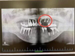 ＜インプラント実例掲載＞サージカルガイドを用いてインプラントを埋入した症例