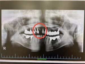 ＜インプラント実例掲載＞サージカルガイドを用いてインプラントを埋入した症例