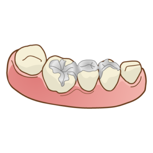 タイトル：「前ろう」vs「後ろう」？あなたに最適なブリッジを選ぶための基礎知識